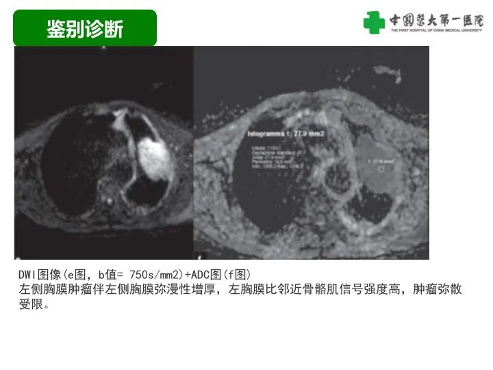 影像PPT - 【病例】胸膜孤立性纤维瘤1例CT影像-26