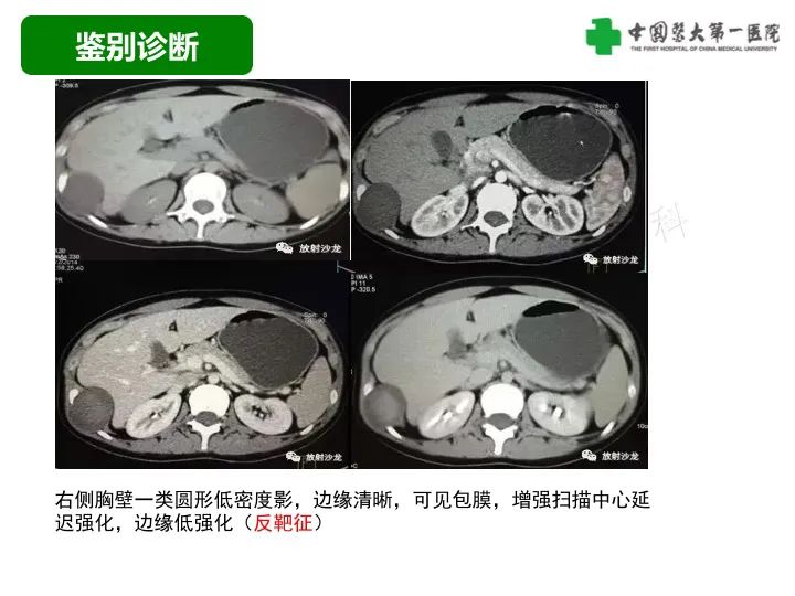 影像PPT - 【病例】胸膜孤立性纤维瘤1例CT影像-29