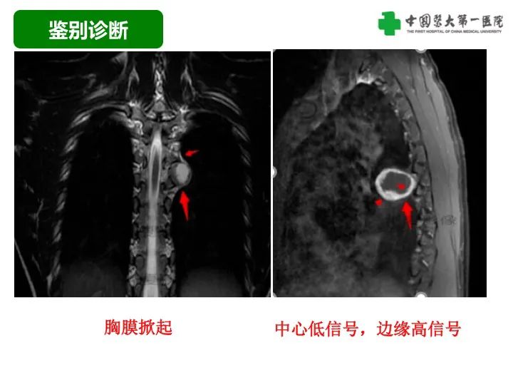 影像PPT - 【病例】胸膜孤立性纤维瘤1例CT影像-30