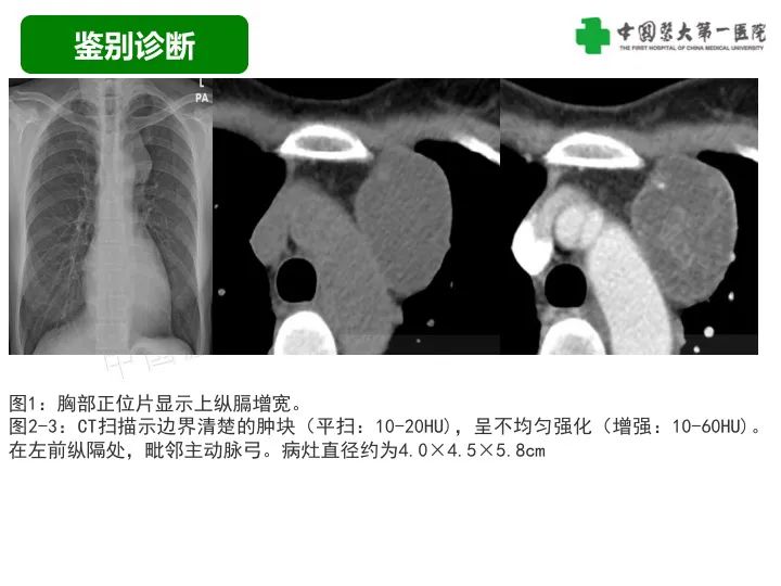 影像PPT - 【病例】胸膜孤立性纤维瘤1例CT影像-31