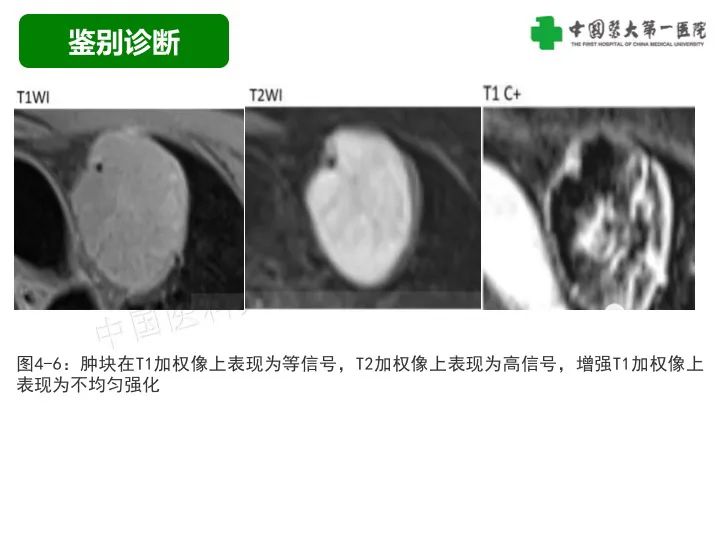 影像PPT - 【病例】胸膜孤立性纤维瘤1例CT影像-32