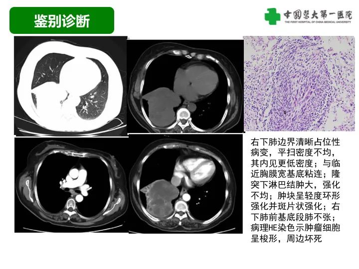 影像PPT - 【病例】胸膜孤立性纤维瘤1例CT影像-35