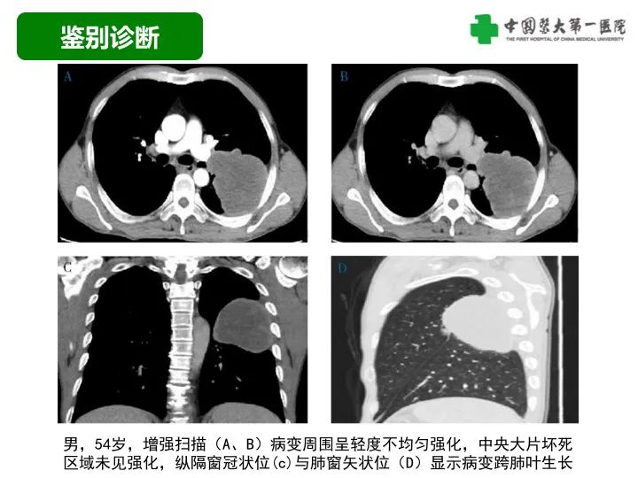 影像PPT - 【病例】胸膜孤立性纤维瘤1例CT影像-36