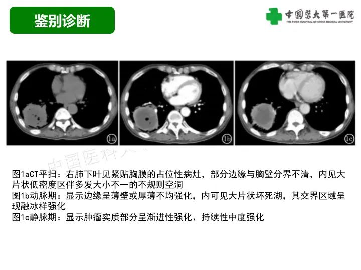 影像PPT - 【病例】胸膜孤立性纤维瘤1例CT影像-37
