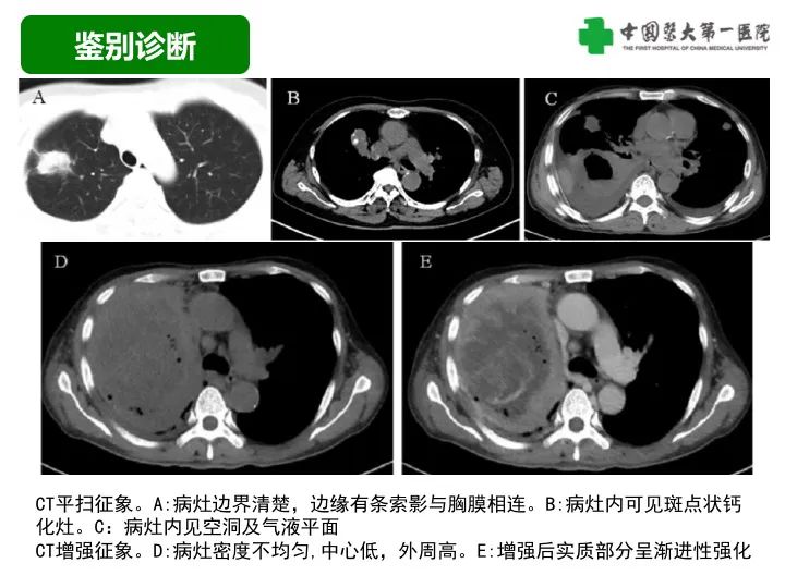 影像PPT - 【病例】胸膜孤立性纤维瘤1例CT影像-38