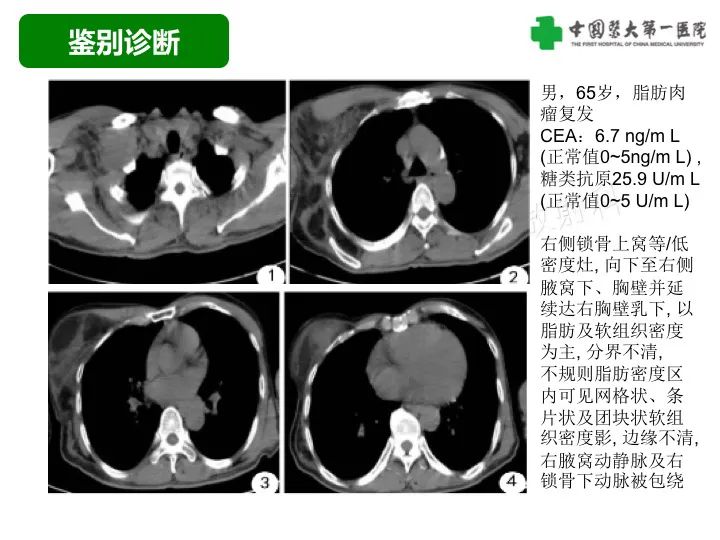 影像PPT - 【病例】胸膜孤立性纤维瘤1例CT影像-42
