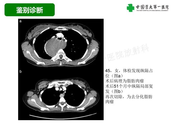 影像PPT - 【病例】胸膜孤立性纤维瘤1例CT影像-43