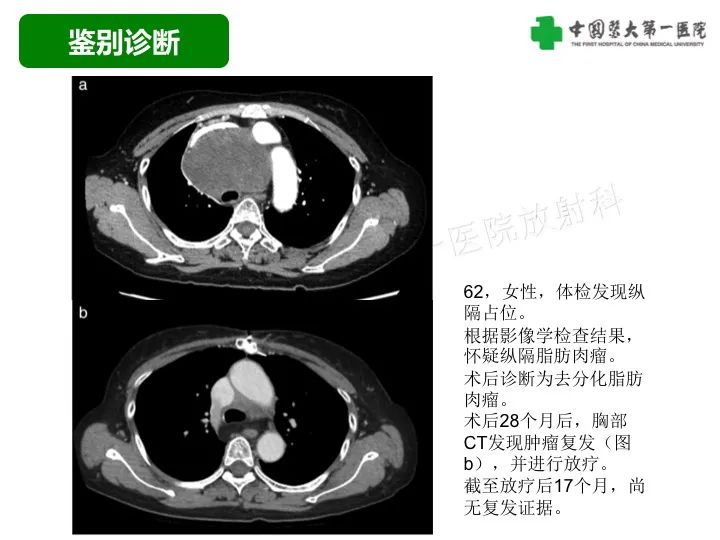 影像PPT - 【病例】胸膜孤立性纤维瘤1例CT影像-44