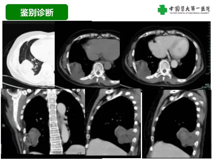 影像PPT - 【病例】胸膜孤立性纤维瘤1例CT影像-45