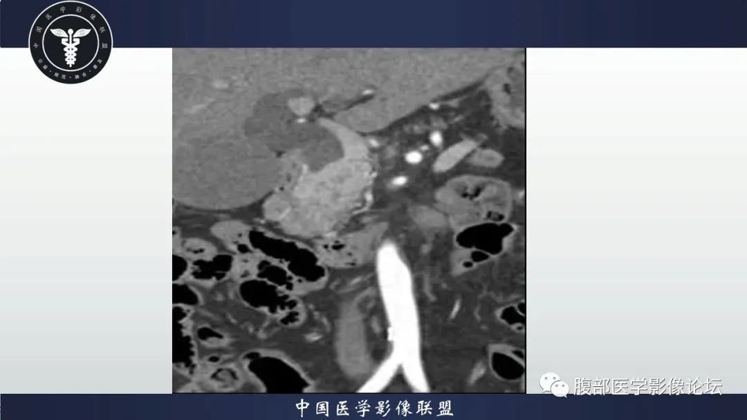影像PPT - 【病例】胰腺神经内分泌肿瘤1例CT影像-5