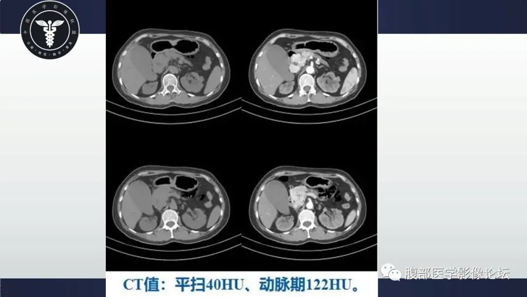 影像PPT - 【病例】胰腺神经内分泌肿瘤1例CT影像-3