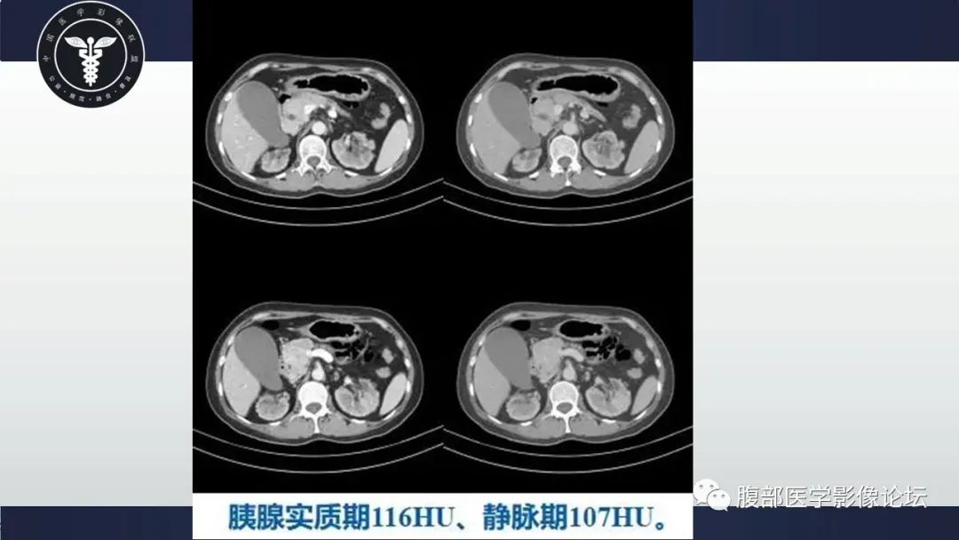 影像PPT - 【病例】胰腺神经内分泌肿瘤1例CT影像-4