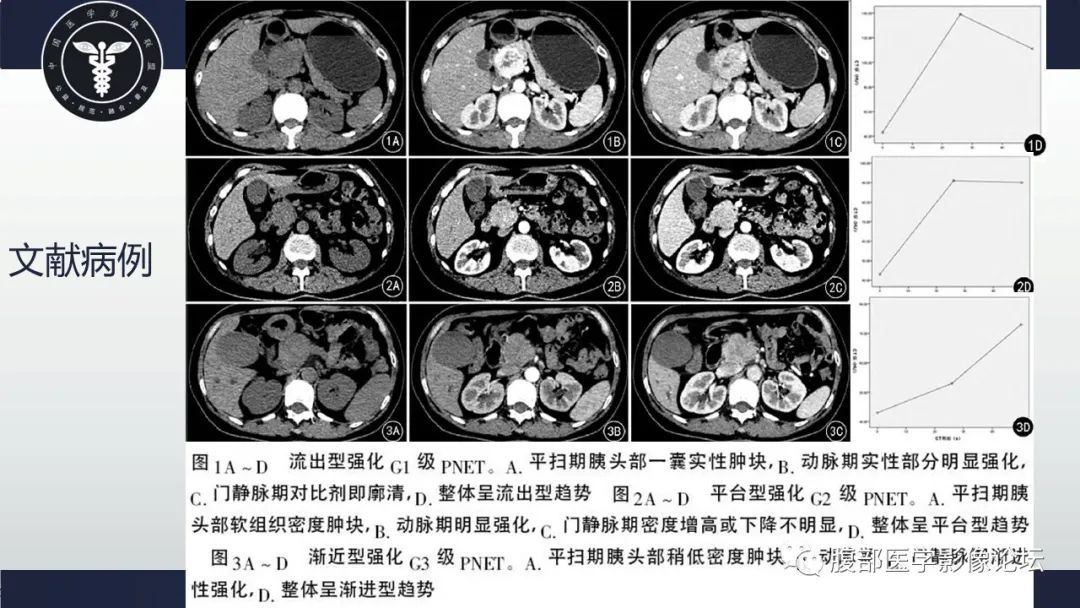 影像PPT - 【病例】胰腺神经内分泌肿瘤1例CT影像-21