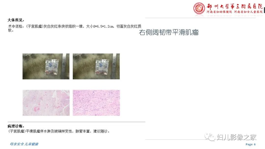 影像PPT - 【PPT】子宫肌瘤变性的影像诊断-6