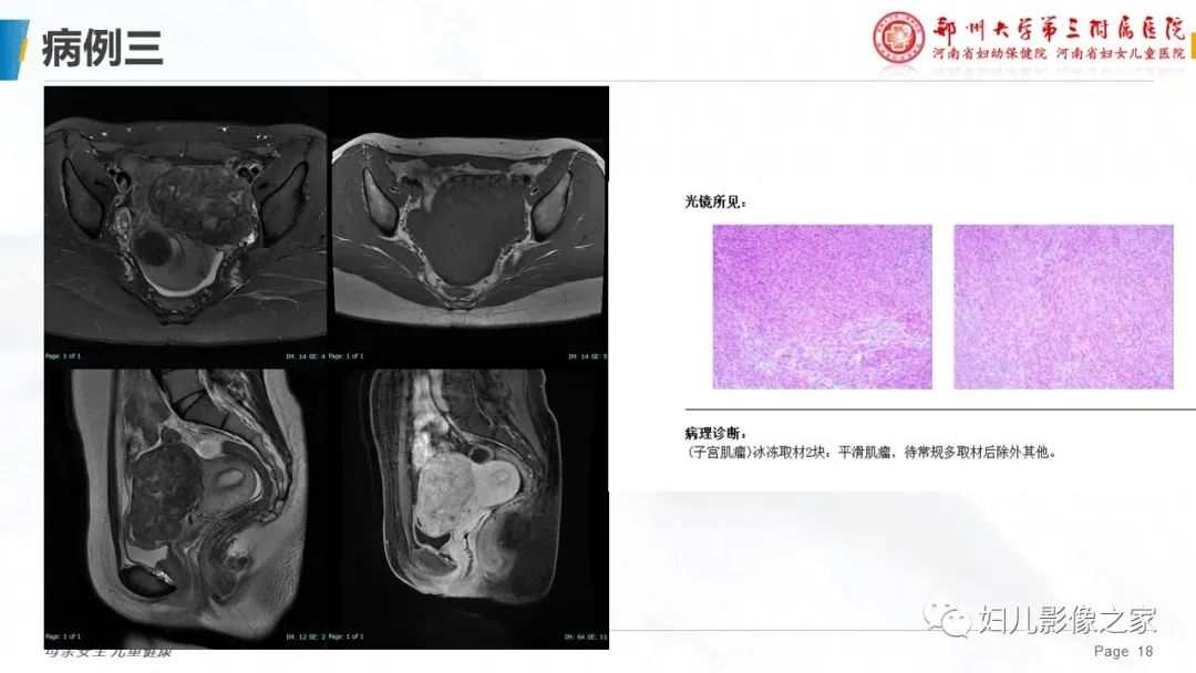 影像PPT - 【PPT】子宫肌瘤变性的影像诊断-18