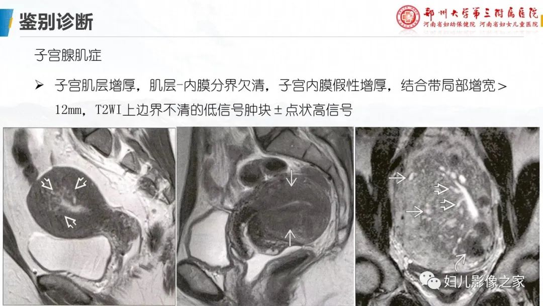 影像PPT - 【PPT】子宫肌瘤变性的影像诊断-24