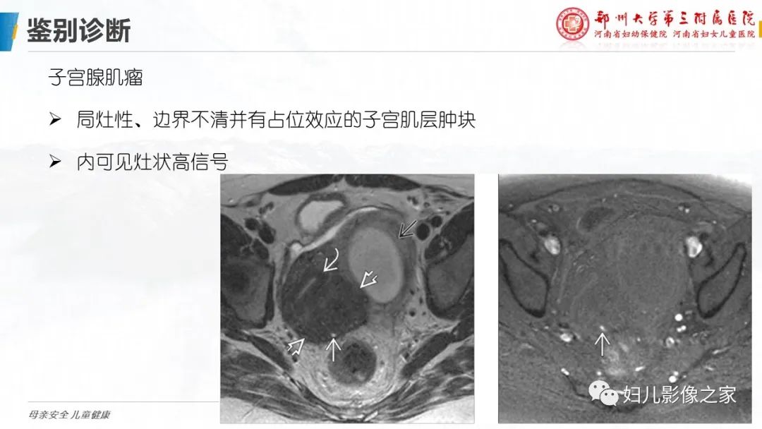 影像PPT - 【PPT】子宫肌瘤变性的影像诊断-25