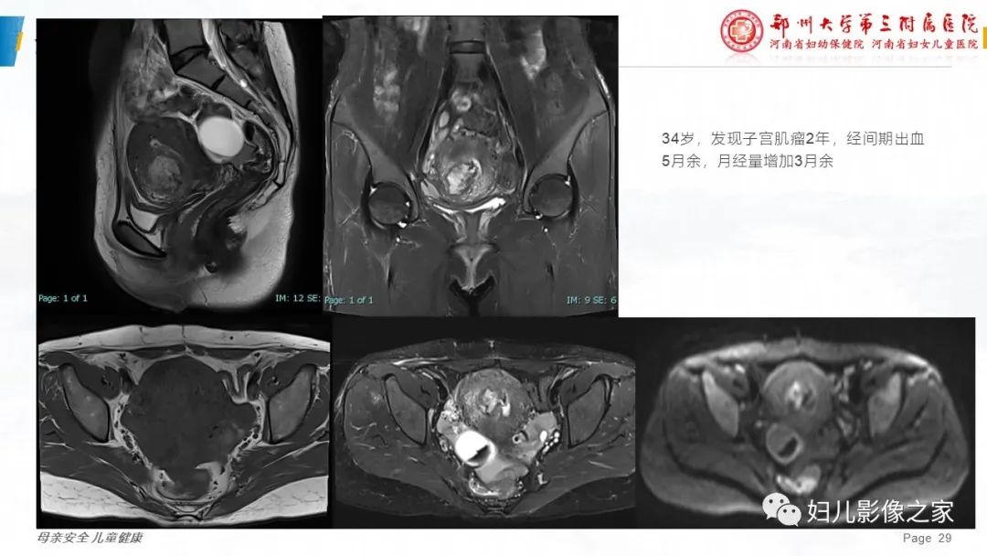影像PPT - 【PPT】子宫肌瘤变性的影像诊断-29