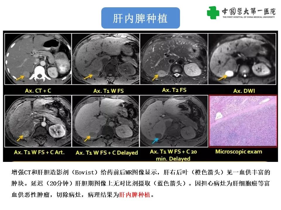 影像PPT - 【PPT】腹部及盆腔脾种植不典型表现、诊断陷阱及鉴别诊断-8