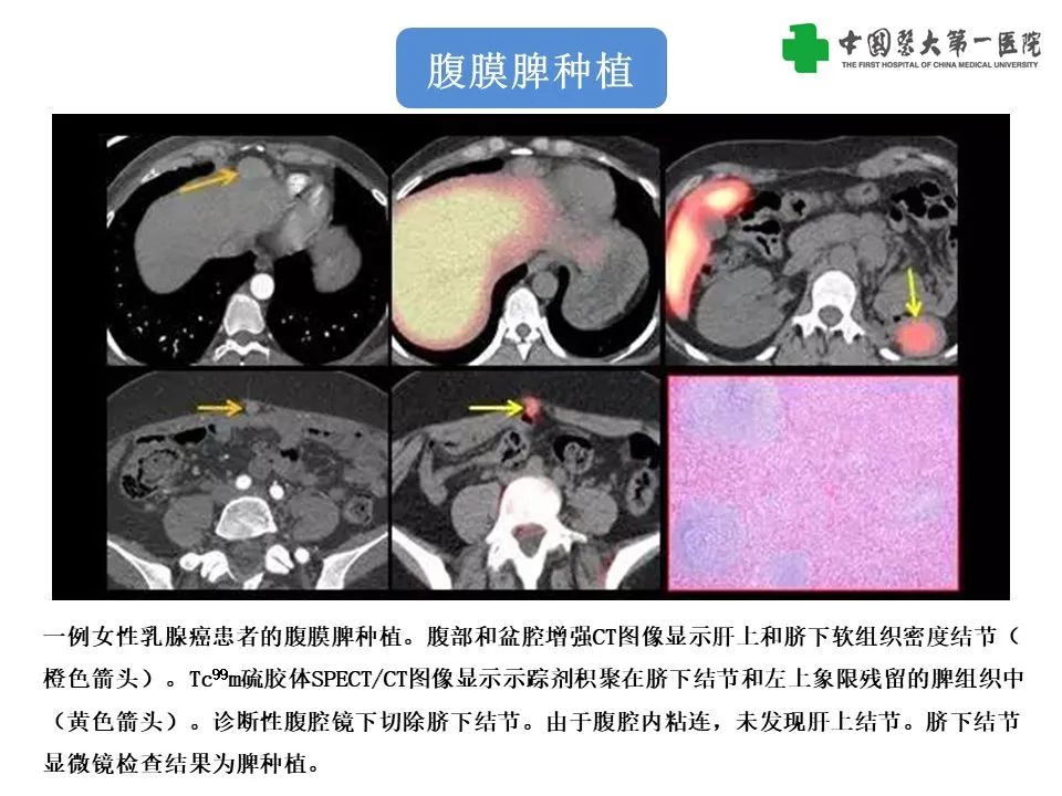 影像PPT - 【PPT】腹部及盆腔脾种植不典型表现、诊断陷阱及鉴别诊断-11