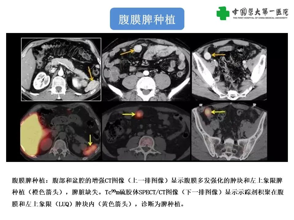 影像PPT - 【PPT】腹部及盆腔脾种植不典型表现、诊断陷阱及鉴别诊断-10
