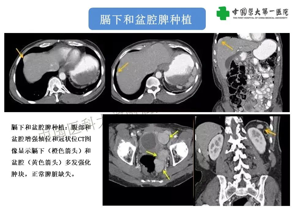 影像PPT - 【PPT】腹部及盆腔脾种植不典型表现、诊断陷阱及鉴别诊断-13