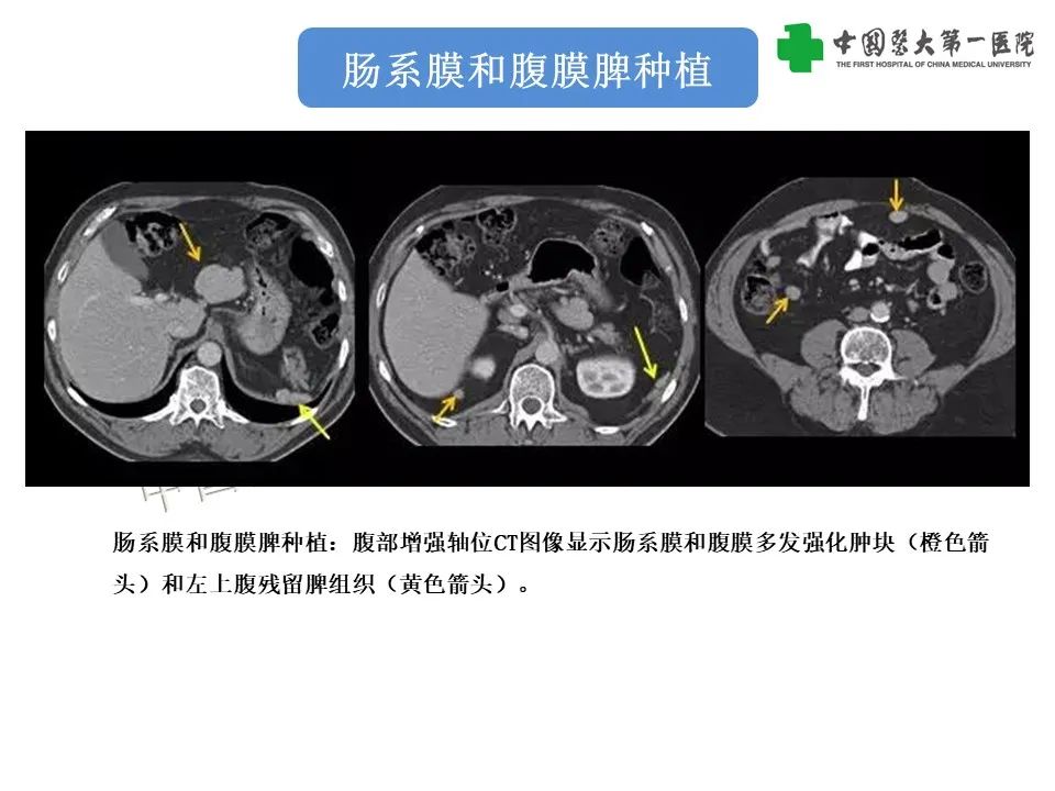 影像PPT - 【PPT】腹部及盆腔脾种植不典型表现、诊断陷阱及鉴别诊断-14