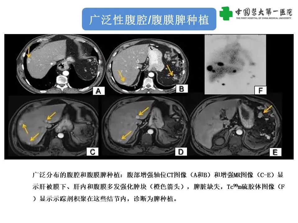 影像PPT - 【PPT】腹部及盆腔脾种植不典型表现、诊断陷阱及鉴别诊断-15
