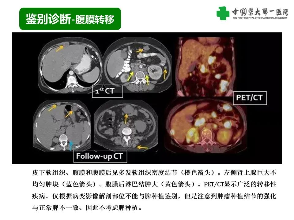 影像PPT - 【PPT】腹部及盆腔脾种植不典型表现、诊断陷阱及鉴别诊断-16