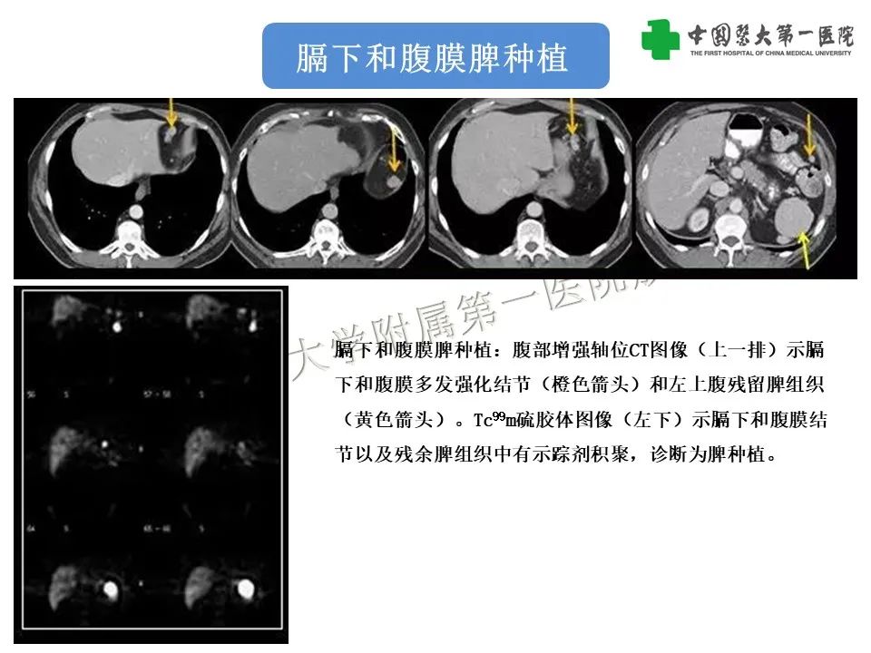 影像PPT - 【PPT】腹部及盆腔脾种植不典型表现、诊断陷阱及鉴别诊断-12