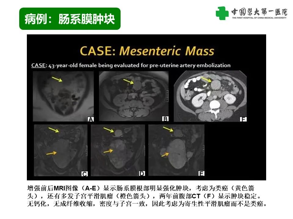 影像PPT - 【PPT】腹部及盆腔脾种植不典型表现、诊断陷阱及鉴别诊断-18