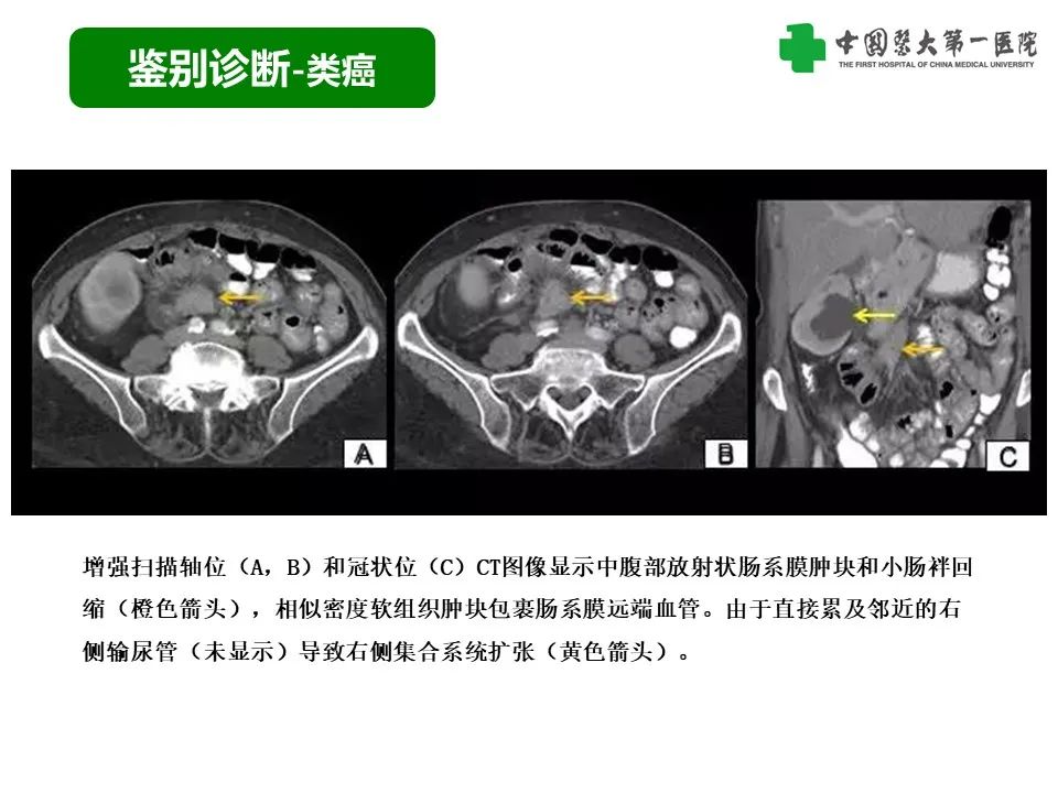 影像PPT - 【PPT】腹部及盆腔脾种植不典型表现、诊断陷阱及鉴别诊断-20