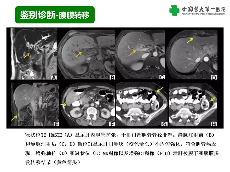 影像PPT - 【PPT】腹部及盆腔脾种植不典型表现、诊断陷阱及鉴别诊断-17