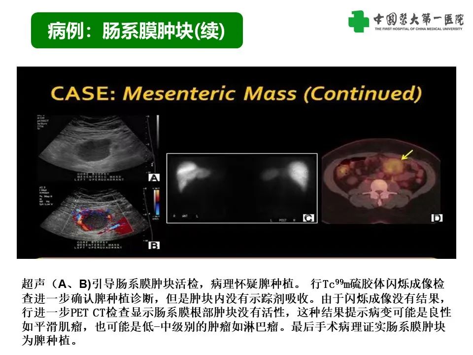 影像PPT - 【PPT】腹部及盆腔脾种植不典型表现、诊断陷阱及鉴别诊断-19