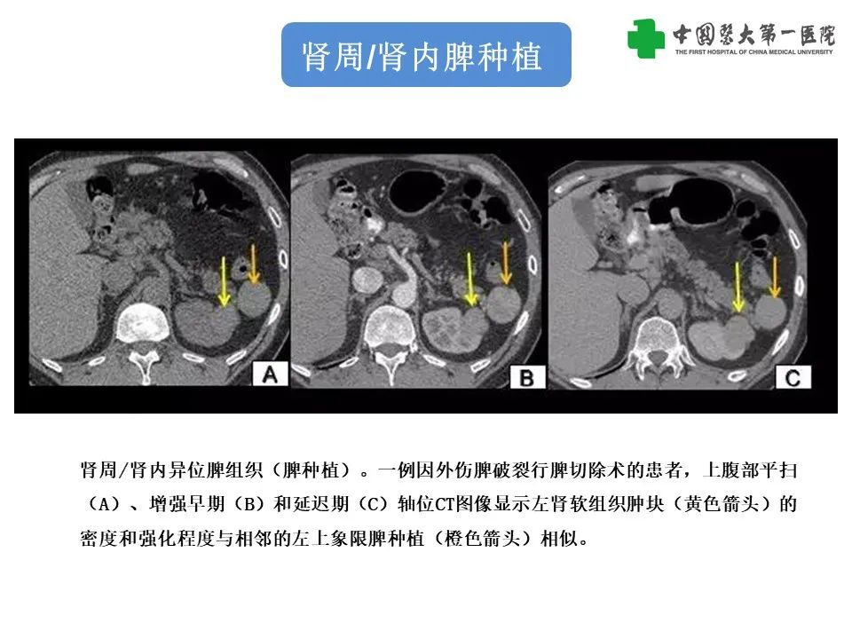 影像PPT - 【PPT】腹部及盆腔脾种植不典型表现、诊断陷阱及鉴别诊断-21