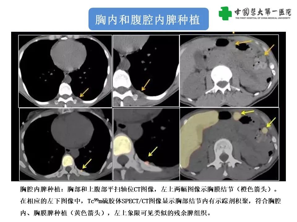 影像PPT - 【PPT】腹部及盆腔脾种植不典型表现、诊断陷阱及鉴别诊断-24