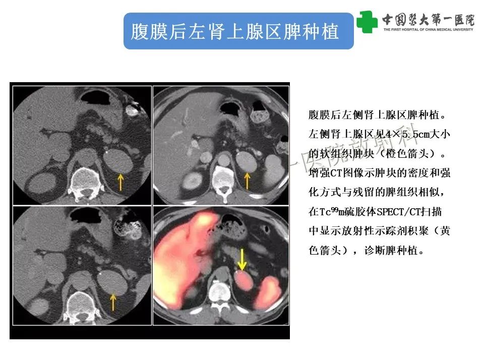 影像PPT - 【PPT】腹部及盆腔脾种植不典型表现、诊断陷阱及鉴别诊断-22