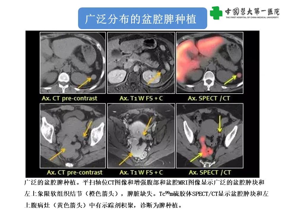 影像PPT - 【PPT】腹部及盆腔脾种植不典型表现、诊断陷阱及鉴别诊断-25