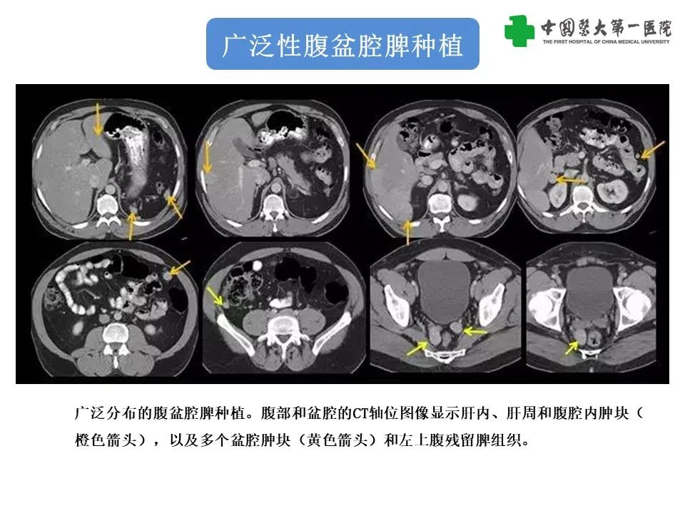 影像PPT - 【PPT】腹部及盆腔脾种植不典型表现、诊断陷阱及鉴别诊断-23