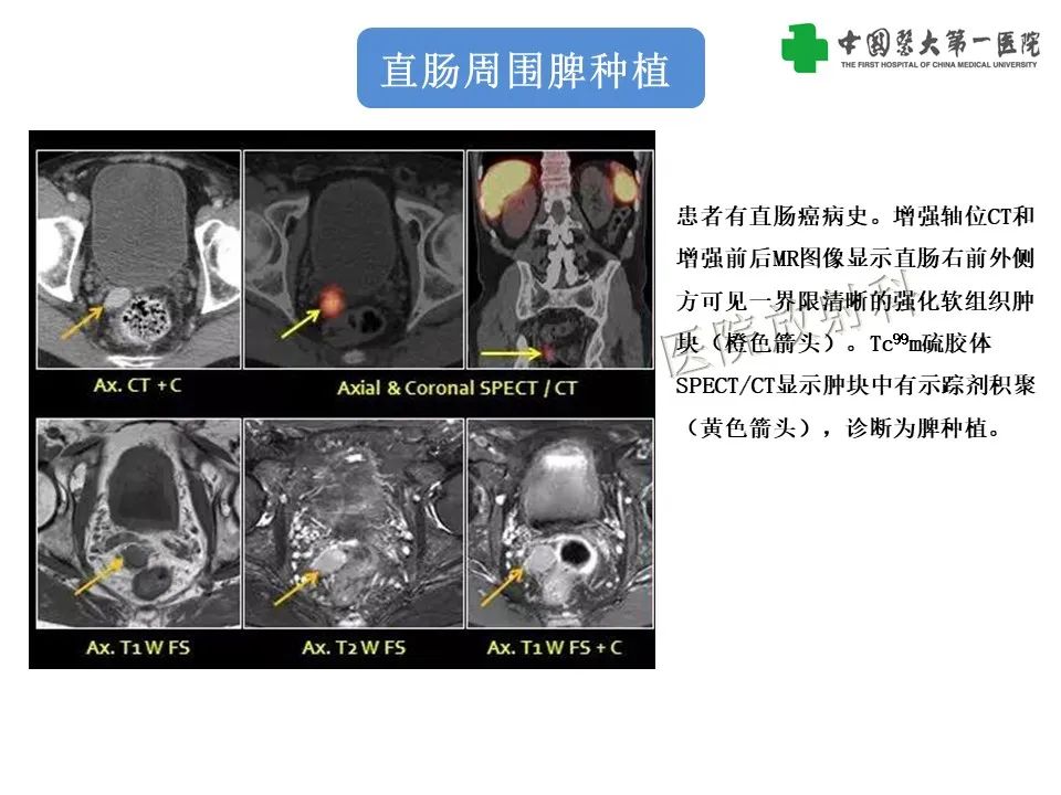 影像PPT - 【PPT】腹部及盆腔脾种植不典型表现、诊断陷阱及鉴别诊断-26