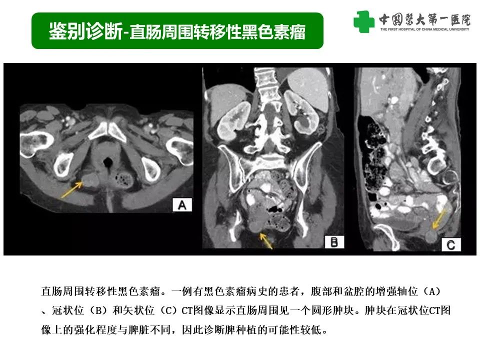 影像PPT - 【PPT】腹部及盆腔脾种植不典型表现、诊断陷阱及鉴别诊断-28