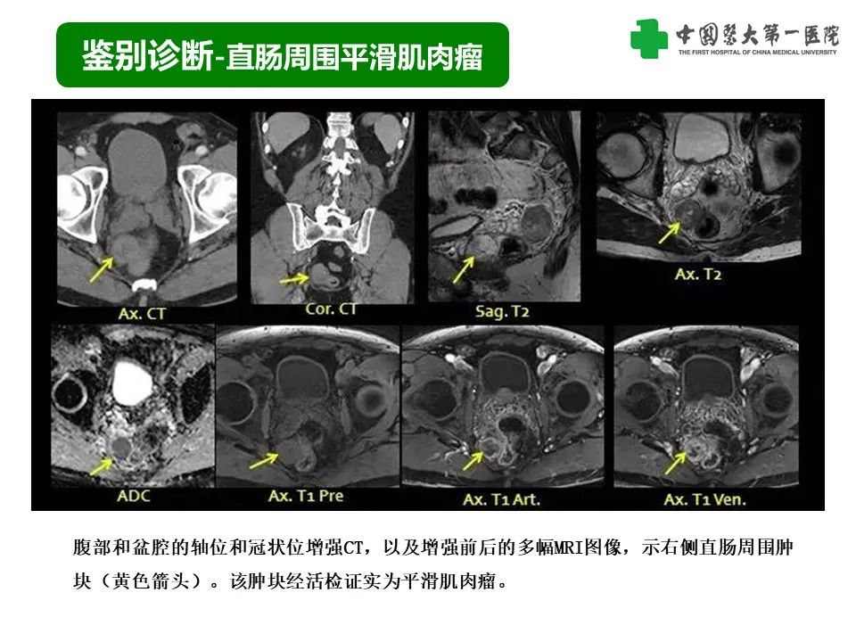 影像PPT - 【PPT】腹部及盆腔脾种植不典型表现、诊断陷阱及鉴别诊断-30