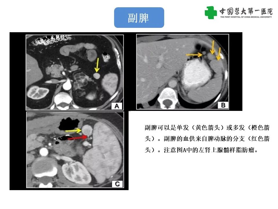 影像PPT - 【PPT】腹部及盆腔脾种植不典型表现、诊断陷阱及鉴别诊断-32