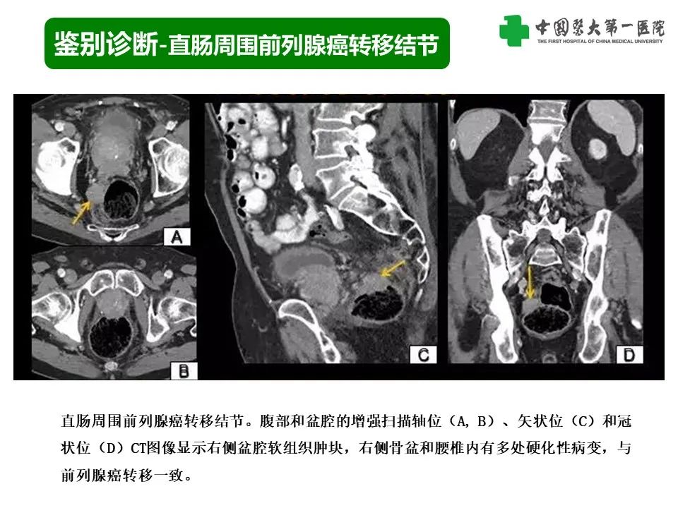 影像PPT - 【PPT】腹部及盆腔脾种植不典型表现、诊断陷阱及鉴别诊断-29