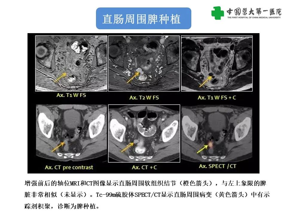 影像PPT - 【PPT】腹部及盆腔脾种植不典型表现、诊断陷阱及鉴别诊断-27