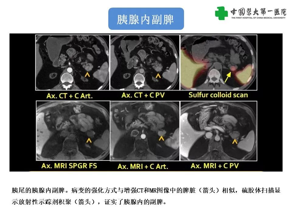 影像PPT - 【PPT】腹部及盆腔脾种植不典型表现、诊断陷阱及鉴别诊断-33