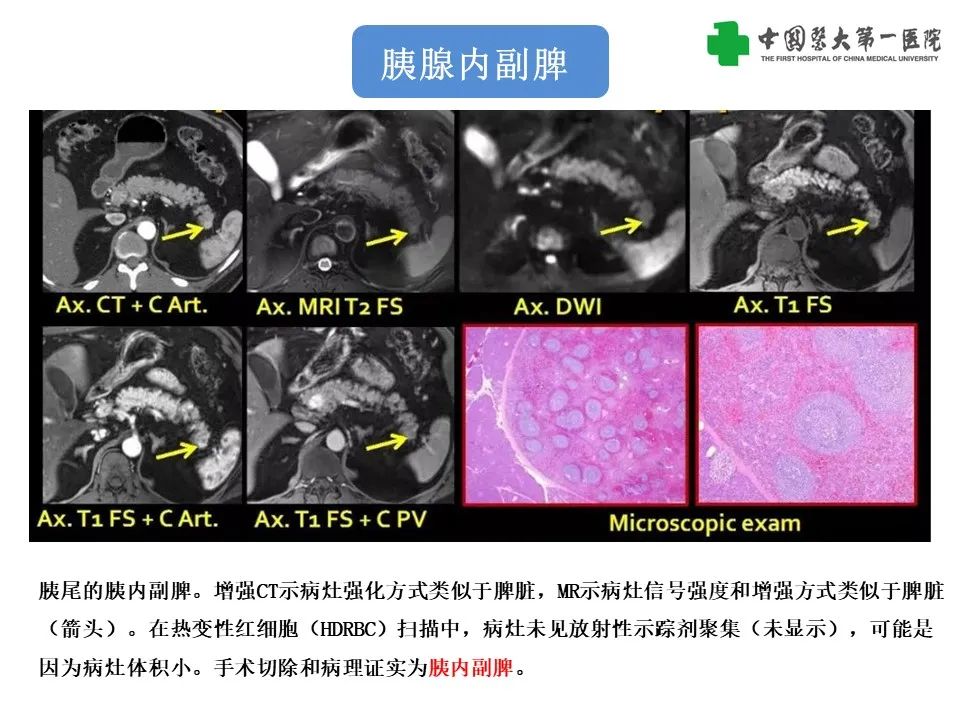 影像PPT - 【PPT】腹部及盆腔脾种植不典型表现、诊断陷阱及鉴别诊断-34