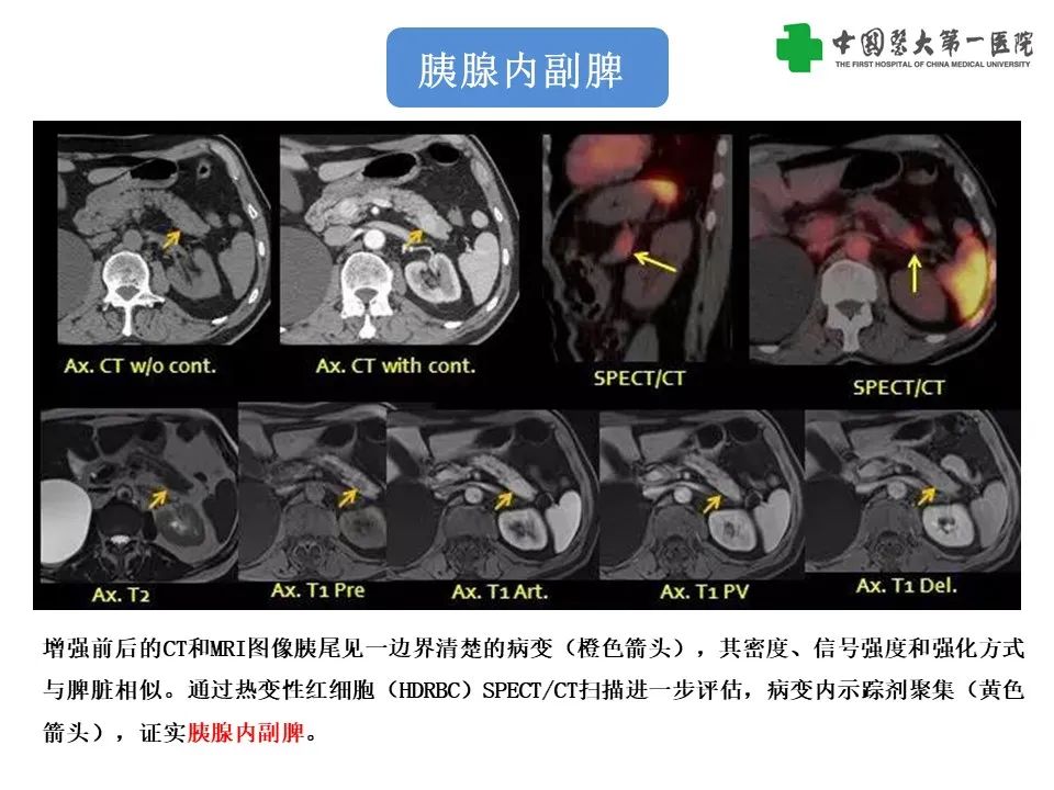 影像PPT - 【PPT】腹部及盆腔脾种植不典型表现、诊断陷阱及鉴别诊断-35