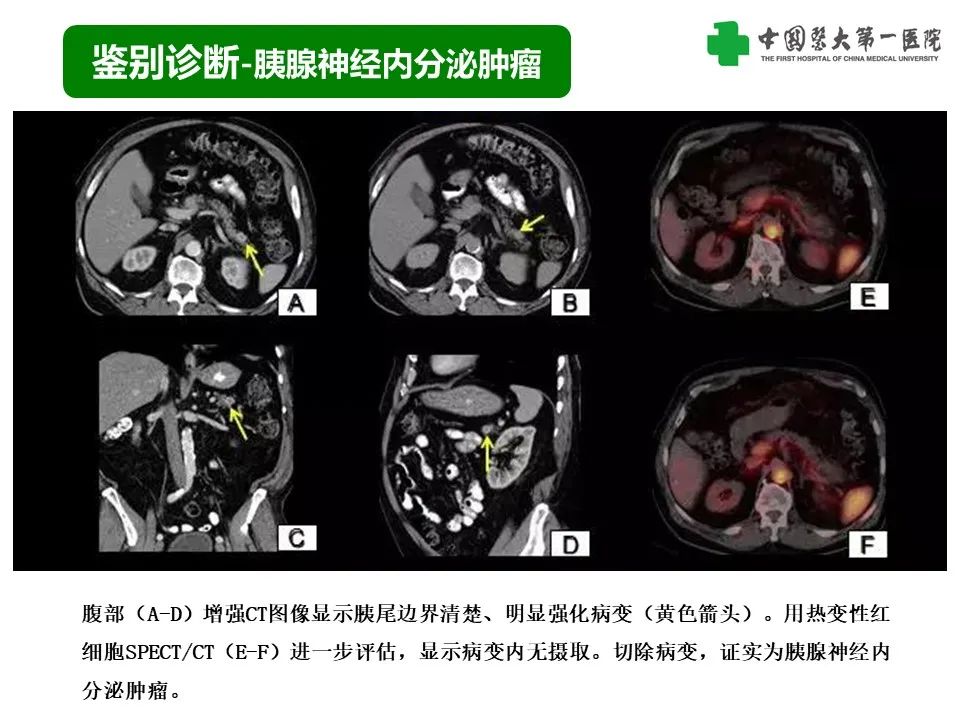 影像PPT - 【PPT】腹部及盆腔脾种植不典型表现、诊断陷阱及鉴别诊断-36