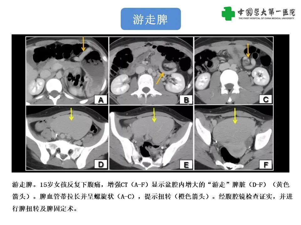 影像PPT - 【PPT】腹部及盆腔脾种植不典型表现、诊断陷阱及鉴别诊断-38